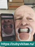 Стоматологический тур в Китай результат протезирования